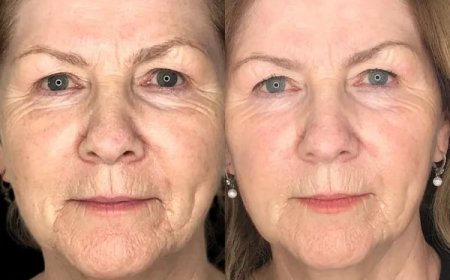 Illuminate Skin with Profhilo by Best Aesthetic Clinic in dubai