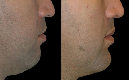 The Best Aesthetic Clinics in Dubai for Chin Fillers: Get the Jawline You Want