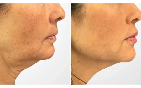 How Thread Lift in Dubai Can Enhance Jawline and Neck Definition
