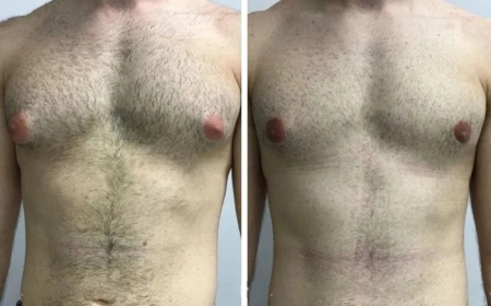 Gynecomastia in Dubai: Recovery Timeline and Aftercare Tips