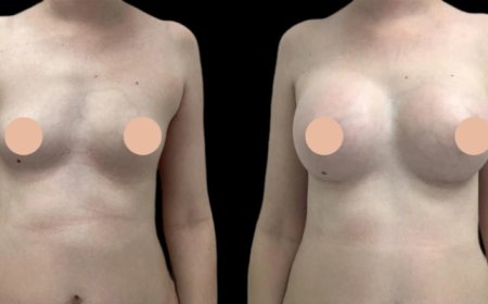 Behind the Results: Dubai’s Breast Augmentation Revolution