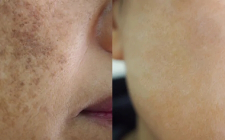 Pigmentation Treatment: How to Choose Between Chemical Peels, Laser, and Microneedling