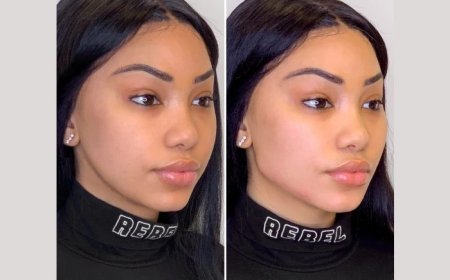 Best Doctors in Dubai for Thread Lift: What Is the Cost of a Thread Lift in Dubai