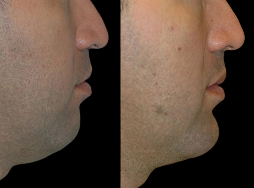 The Best Aesthetic Clinics in Dubai for Chin Fillers: Get the Jawline You Want