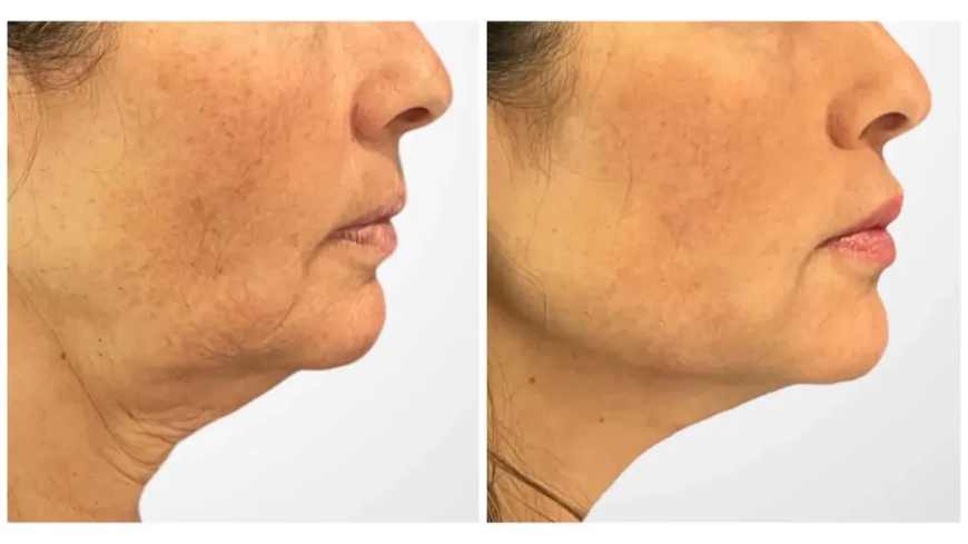 How Thread Lift in Dubai Can Enhance Jawline and Neck Definition