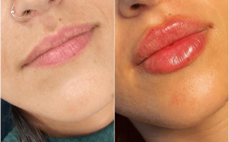 Juvederm for Jawline Contouring: Why It’s Trending at the Best Aesthetic Clinic in Dubai