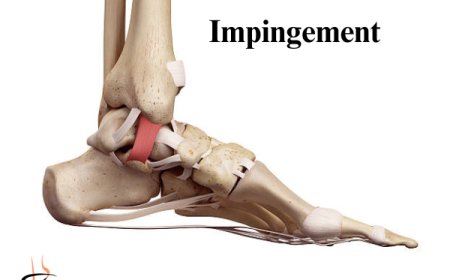 Quick Guide: How to Fix Anterior Ankle Impingement at Home
