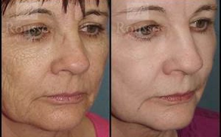 Does It Really Work? Chemical Peel Before and After Results Explained