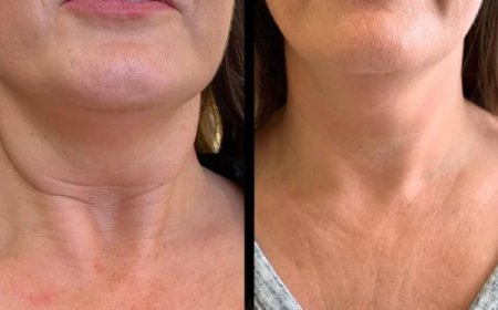 Ignite Elegance using Profhilo from the Best Plastic Surgeons in dubai