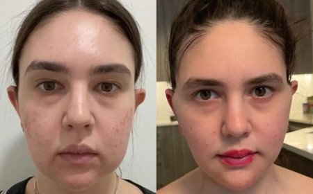 Life After Surgery: Best Buccal fat removal Surgeons in Dubai Share Insights