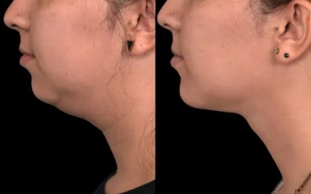 Best Double chin removal Surgeons in Dubai Talk About Weight Fluctuations
