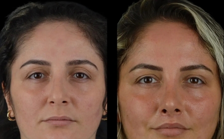Cheek Fillers Safety Standards at the Best Aesthetic Clinics in Dubai