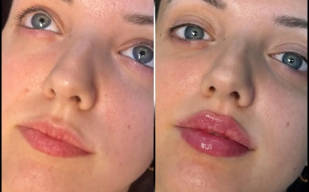 Fillers by the Pros at the Best Aesthetic Clinics in Dubai