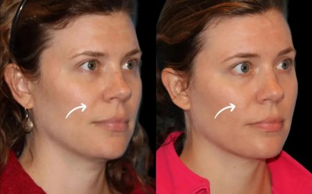 The Evolution of Sculptra Fillers: Best Plastic Surgeons in Dubai Reflect