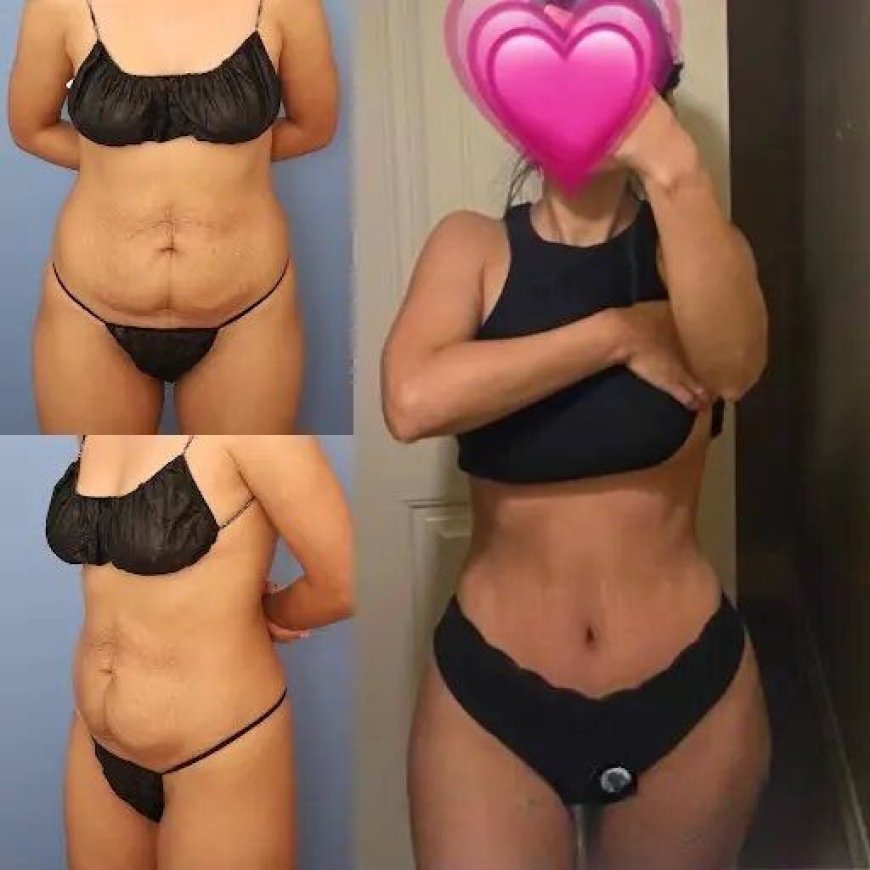 Best Doctors in Dubai for Tummy Tuck: Surgical Excellence Explained