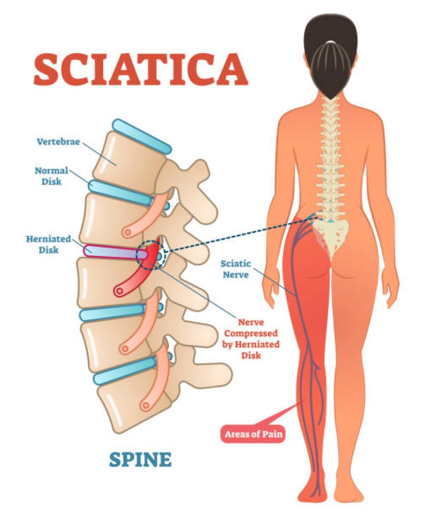 Aspadol 200 mg for Sciatica Pain – Dosage Guidelines & Real‑World Results