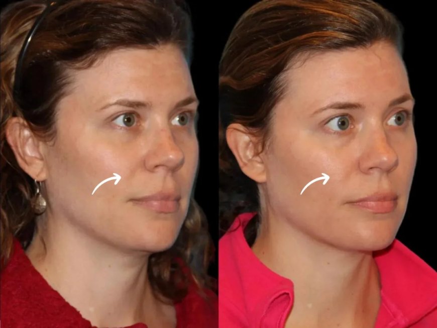 The Evolution of Sculptra Fillers: Best Plastic Surgeons in Dubai Reflect